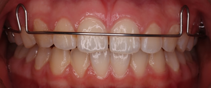 取り外し式の装置により治療しました。