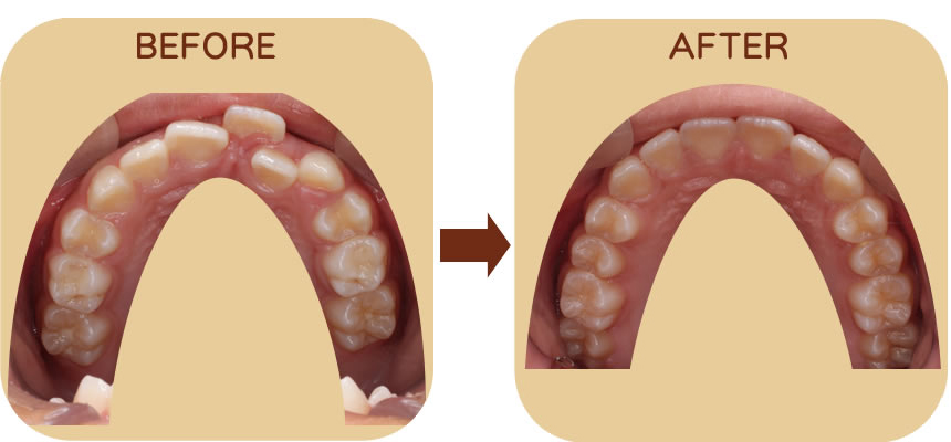 デコボコを防ぐ治療 上顎