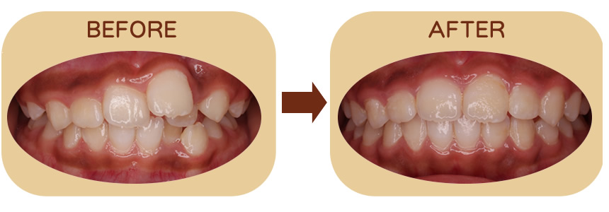 デコボコを防ぐ治療 正面