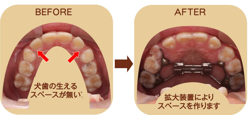 八重歯を防ぐ 上顎