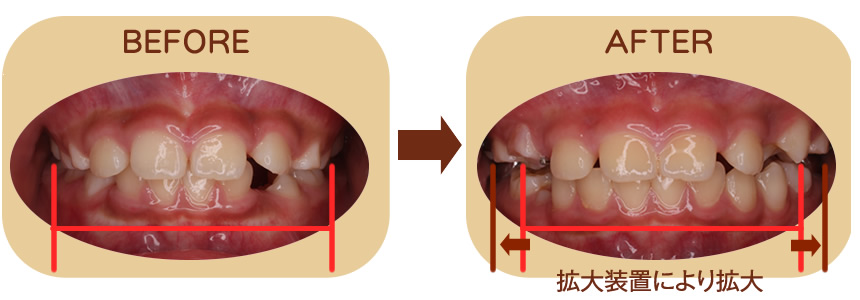 八重歯を防ぐ 正面