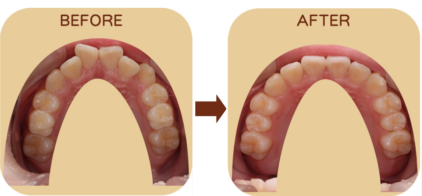 出っ歯を防ぐ 上顎