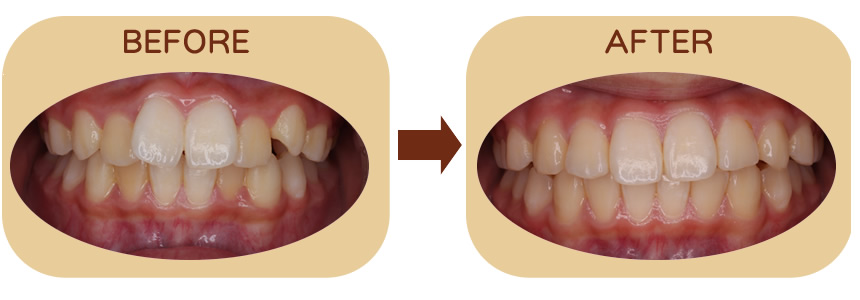 出っ歯を防ぐ 正面