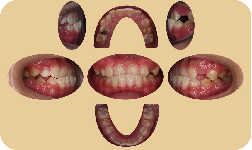小児矯正症例のデータ 初診日