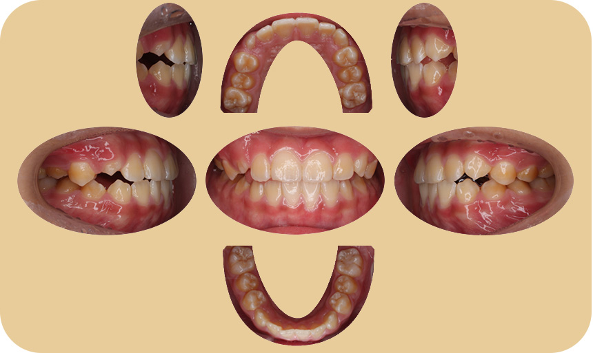 小児矯正症例のデータ 5カ月目
