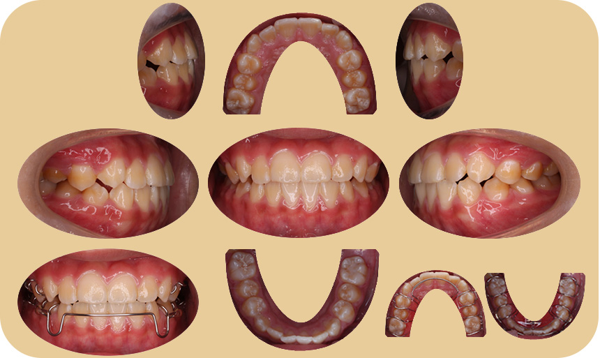 小児矯正症例のデータ 8カ月目