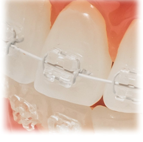 ホワイトワイヤーによる結紮(けっさつ)